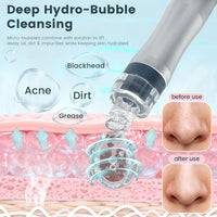 Hydrogen Oxygen Facial Machine, Hydro Facial Machine & Hydrodermabrasion Machine for Skin Care, Facial Vacuum Pore Cleaner, Hydro Dermabrasion Machine for Deep Cleansing & Hydration, Home Use.